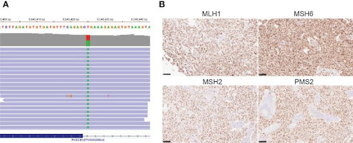 【佳学基因检测】基因检测发现少突胶质细胞瘤IDH 突变和 1p/19q 共缺失并揭示其靶向药物选择